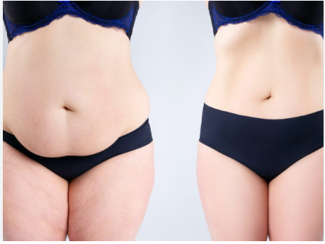 Crafting Beauty with Precision: Discover Tummy Tuck Excellence in Miami