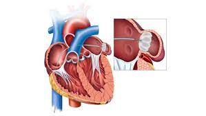 Embracing Innovation: Exploring the Watchman Procedure