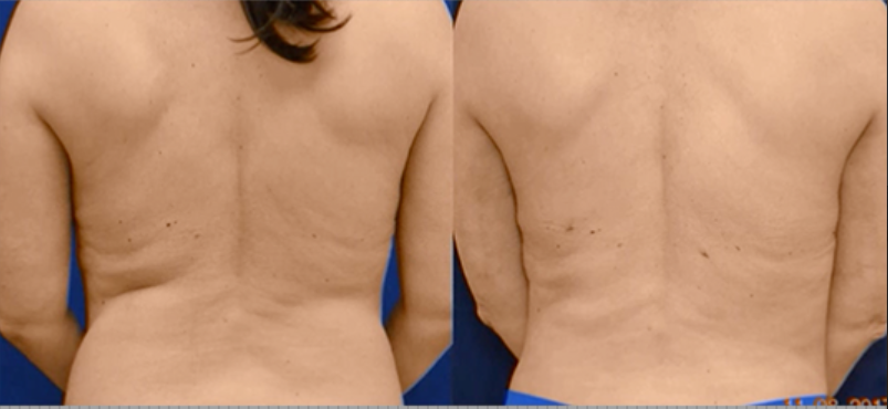 Sculpting Elegance: Liposuction for Breast enhancement