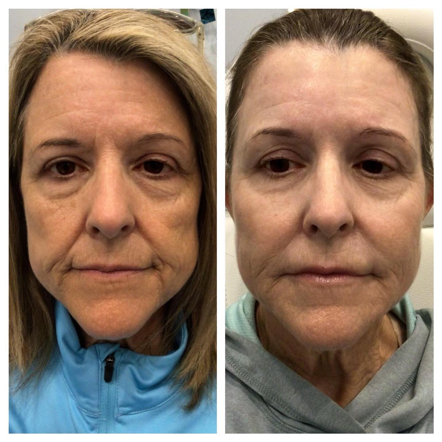 Going through the Positives and negatives of Botox