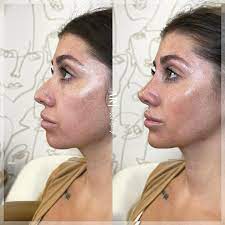 Discover Top-rated Lip Filler Clinics Nearby