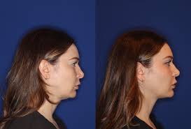 Enhancing Beauty: The SMAS Facelift Experience Before and After