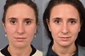 Chin Liposuction in NYC: A Safe and Effective Way to Sculpt Your Face
